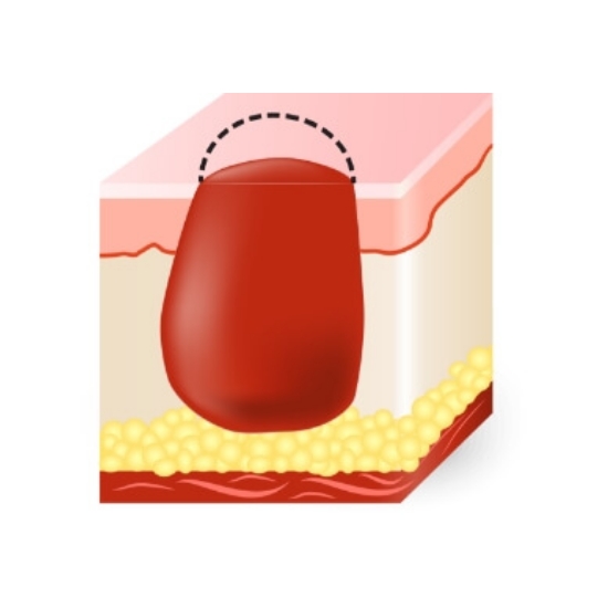 diagram for taking into consideation type and severity of skin cancer