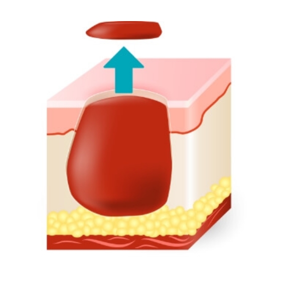 diagram for remove the visible part of the tumor
