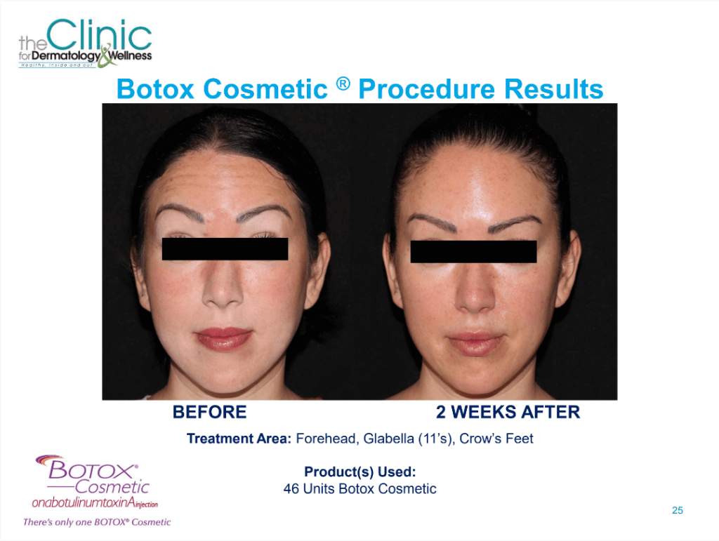 Actual patient who received Botox cosmetic for forehead, Glabella, and crow's feet.