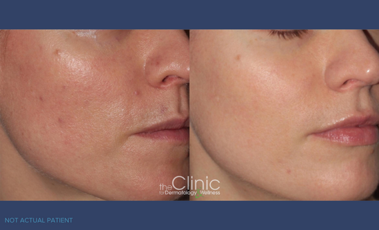 Before & After of woman who received BBL and ClearSilk Treatments (NOT ACTUAL PATIENT) 