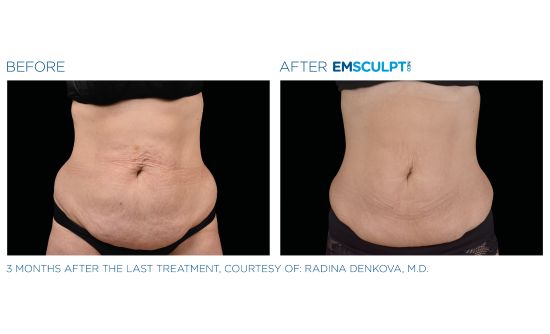 Before and After of woman's abdomen after receiving EMSCULPTNEO, (3 MONTHS ADTER THE LAST TREATMENT, COURTESY OF: RADINA DENKOVA, M.D.)