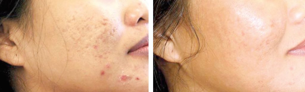 Before and After: This patient is shown after receiving 3 ProFractional scar revision treatments. Photos courtesy of Sciton. 