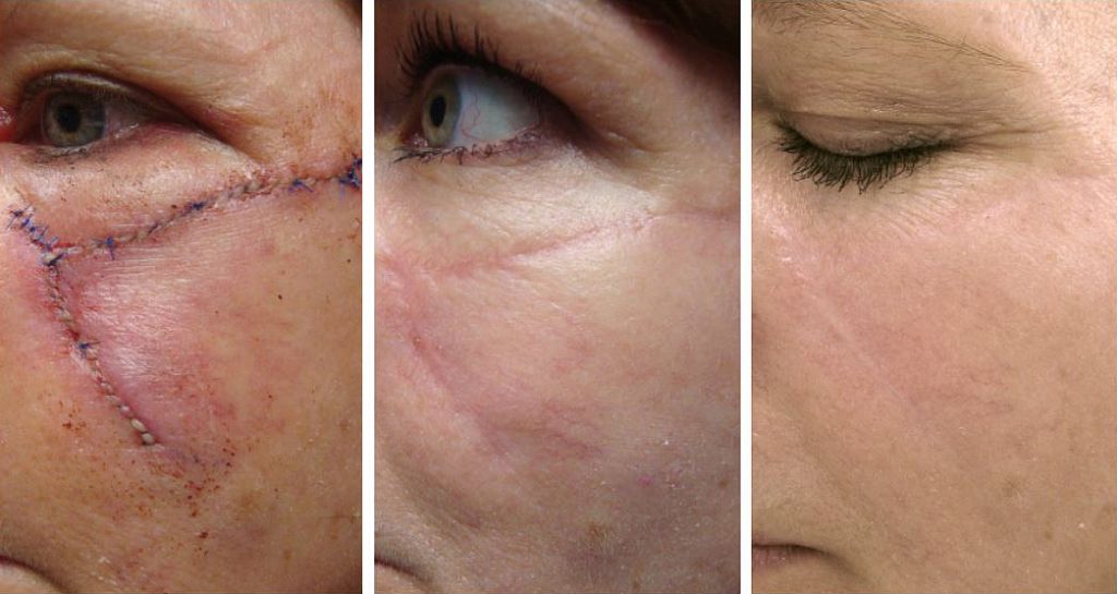 Before and After: This patient is shown before scar revision with the ProFractional laser(left), during the healing process (center), and 3 months post-treatment (right). Photos courtesy of Joel Cohen, MD. 