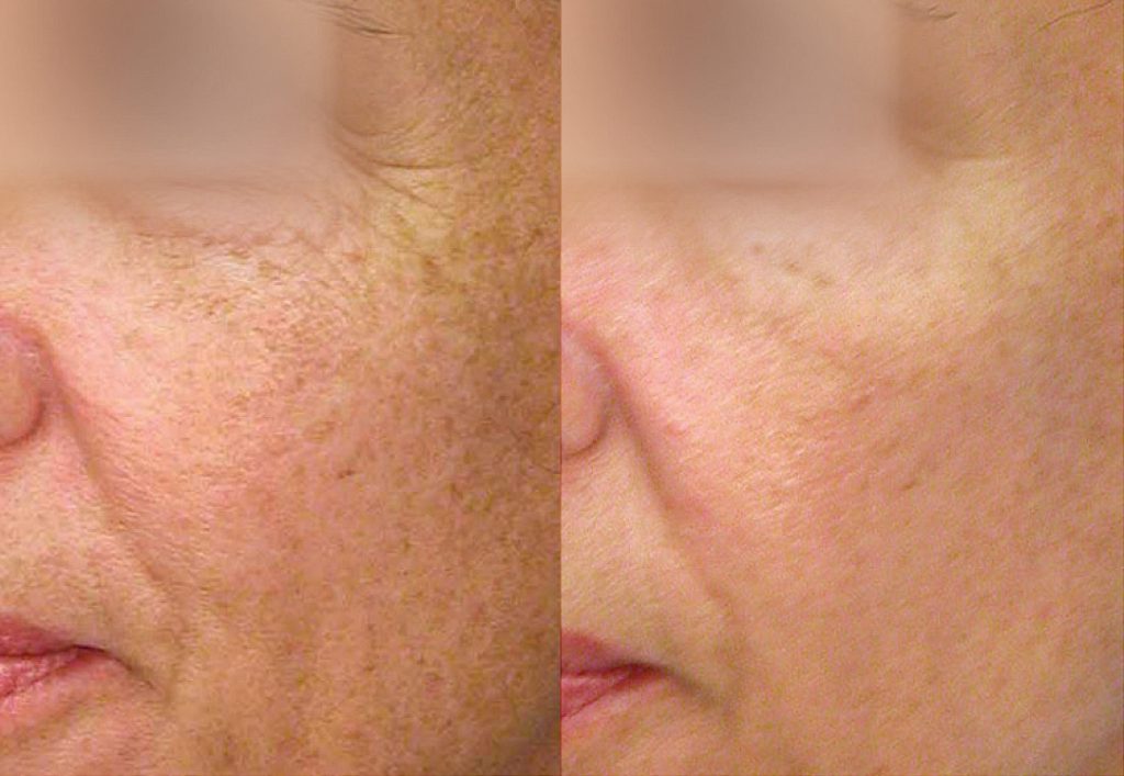 Before and After: This patient is shown 3 months after 5 treatments. Photos courtesy of Jason Pozner, MD, FACS.