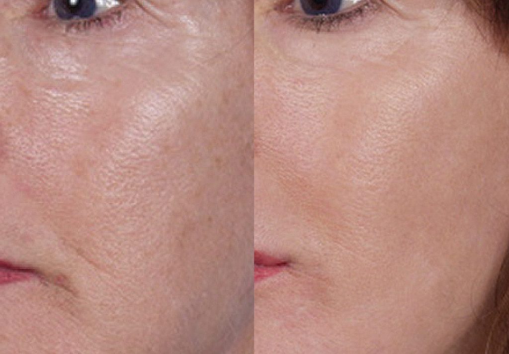 Before and After: This patient is shown 3 months after 5 treatments. Photos courtesy of J. David Holcomb, MD. 