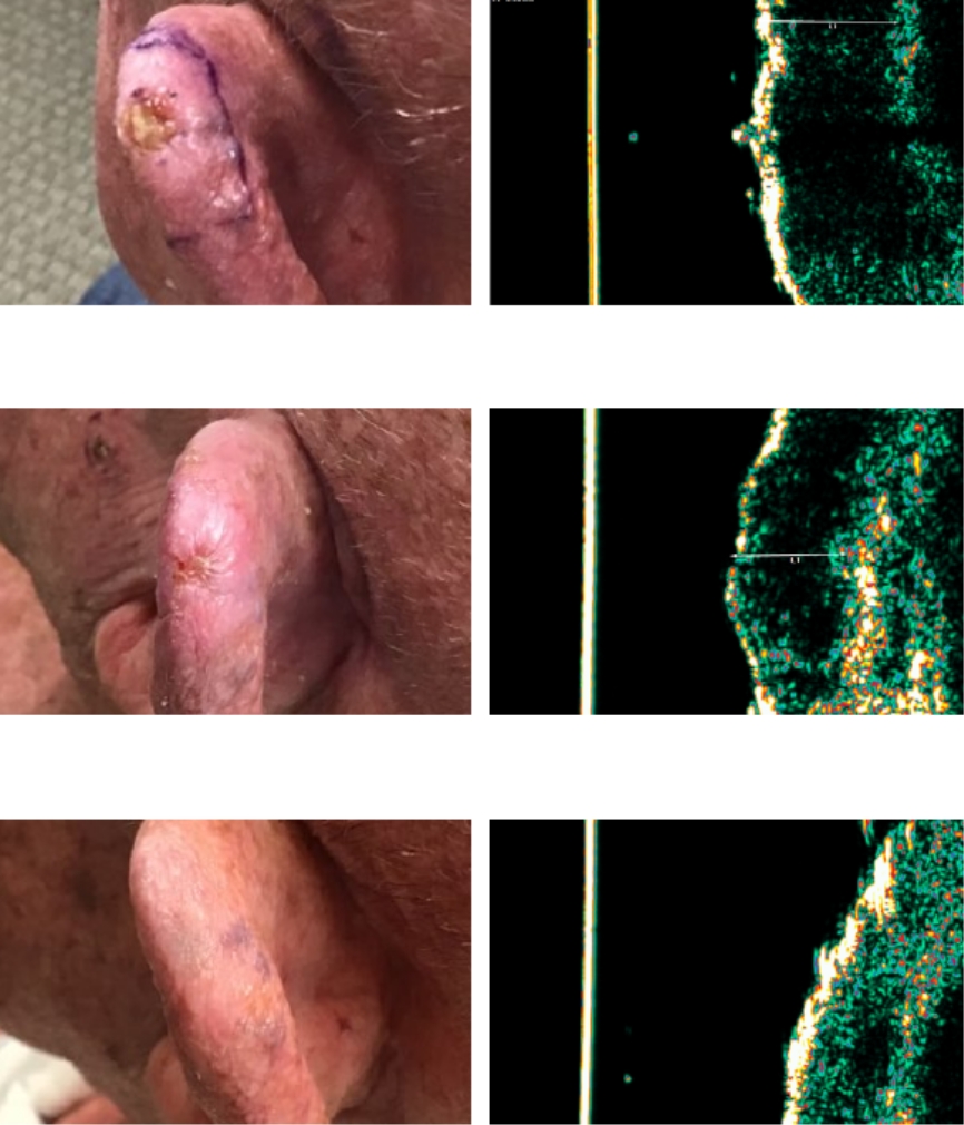 Case Study: Images Taken During GentleCure Treatment & Follow-Up Visit