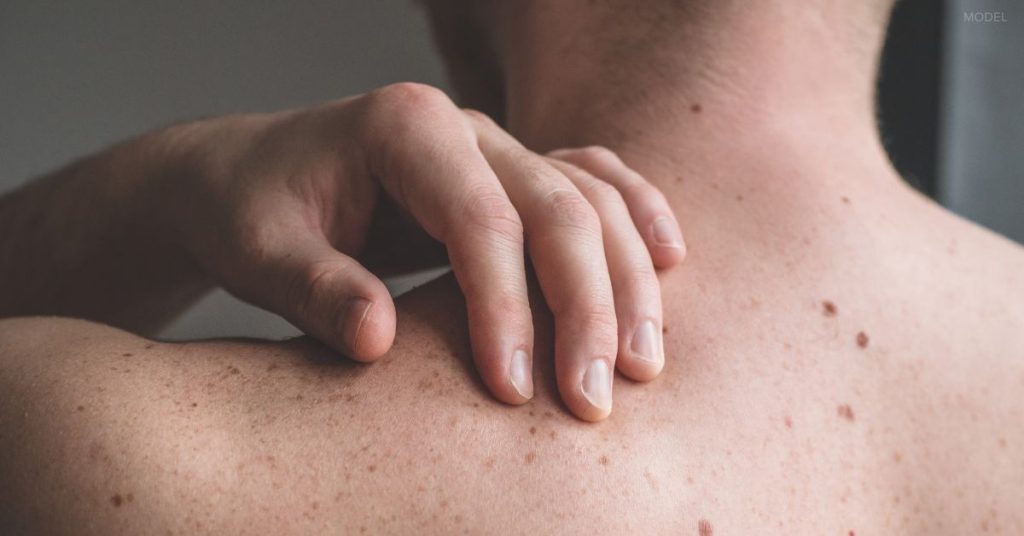 Man with freckles (model) checking the skin on his back.